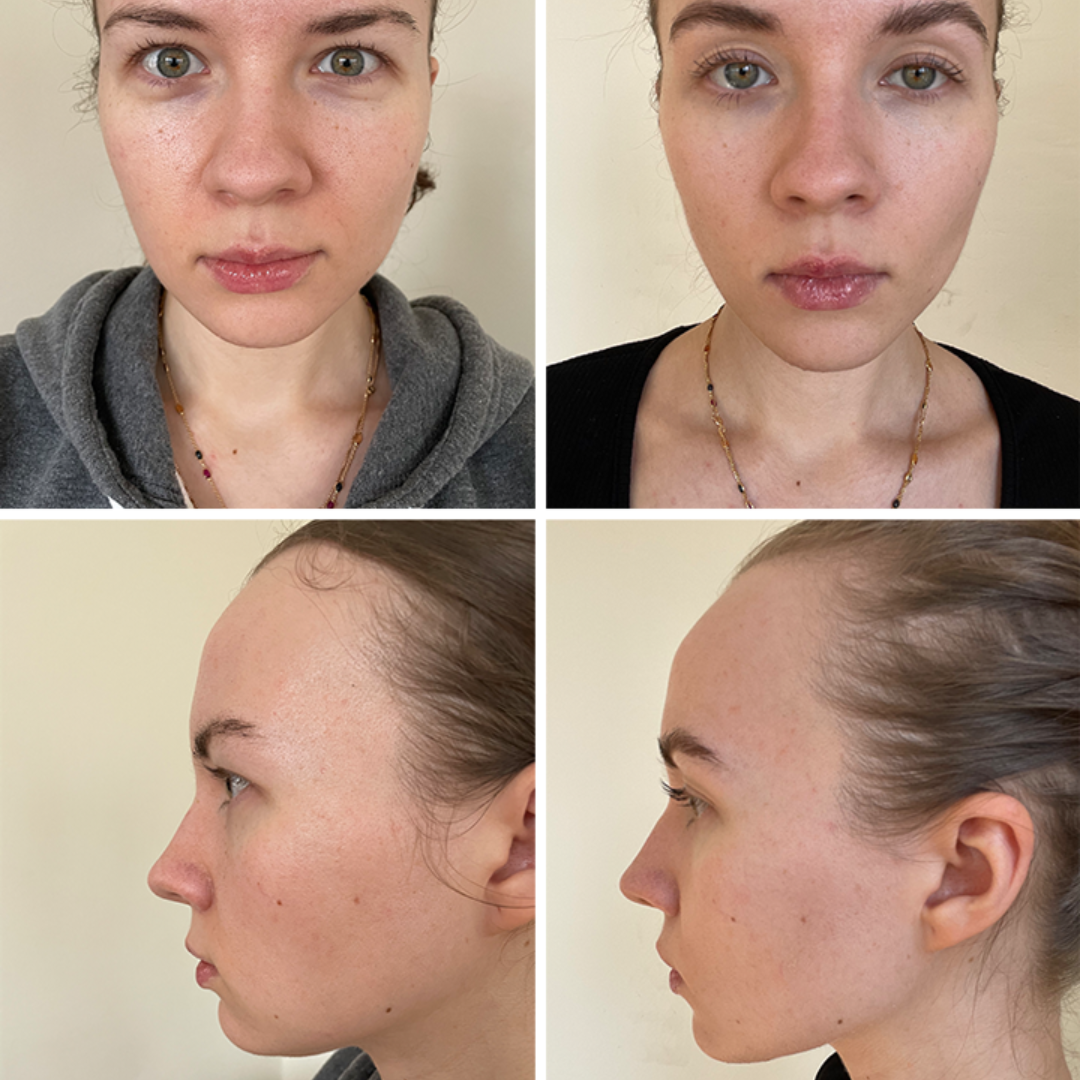 Aluvios™ Facial Sculptor